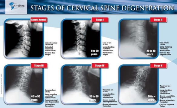 Spine Degeneration