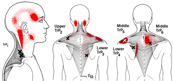 Upper Back Pain: How Chiropractic Can Help Relieve The Pain