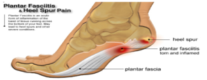 Plantar fasciitis